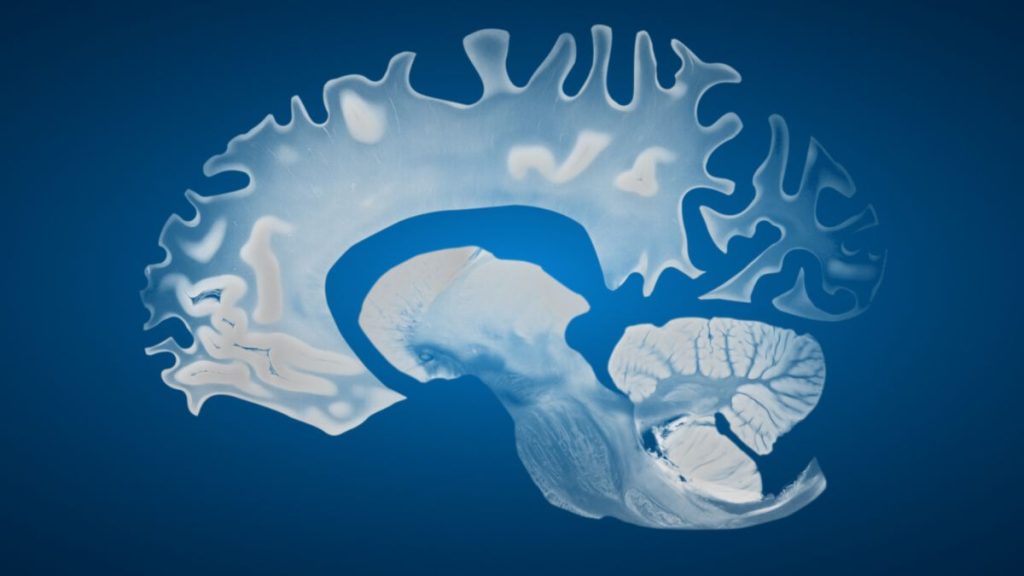 MRI scans showing age-related brain changes and gender brain differences.